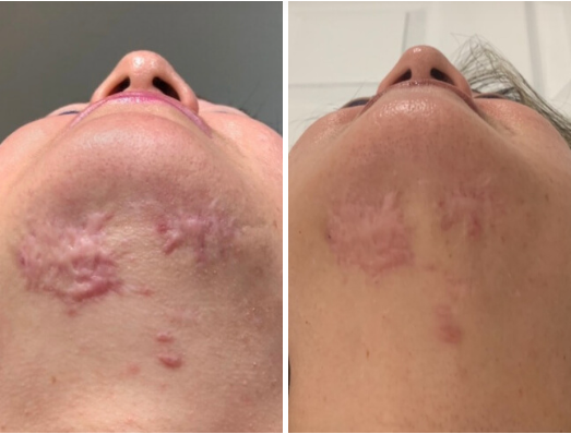 microneedling Virtue RF Microneedling