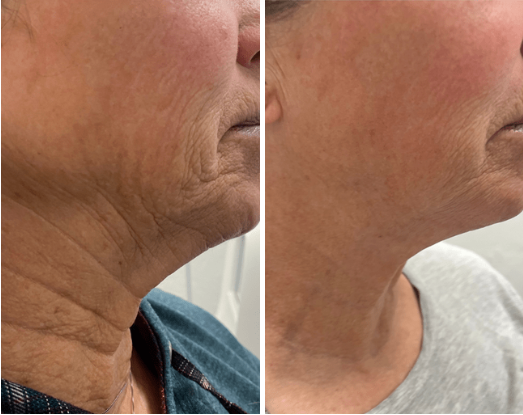 microneedling3 Virtue RF Microneedling
